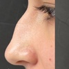 Image 1: Revitalize with Restylane Syringe Options (1.0mL)