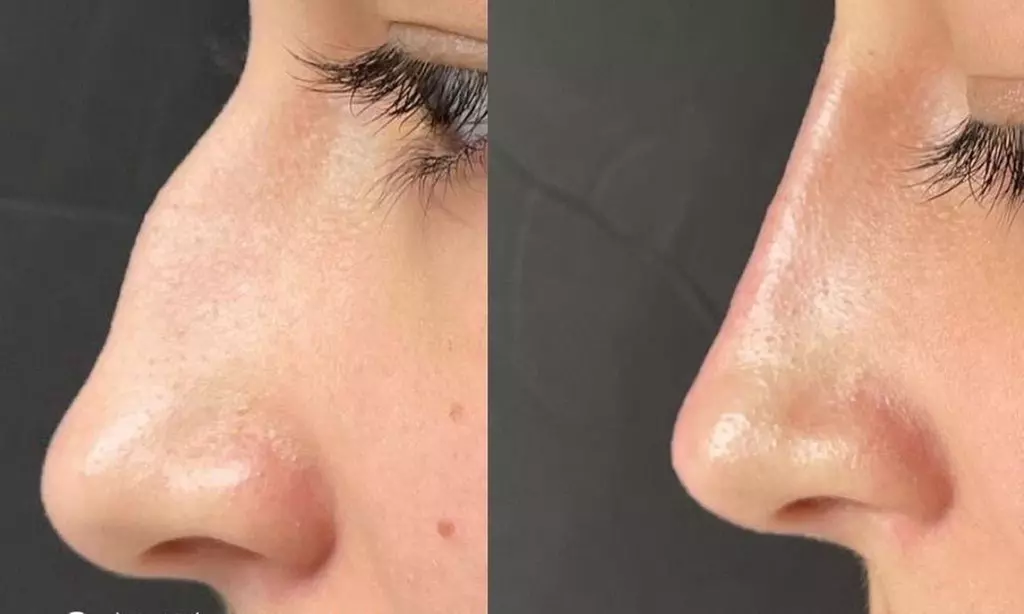 Revitalize with Restylane Syringe Options (1.0mL)