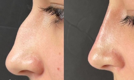One Syringe of Restylane Defyne (1.0mL) - AviMed Medical Beauty