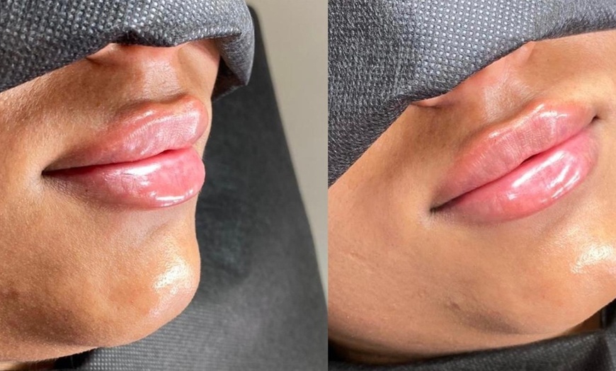 Image 3: Lip Dermal Filler