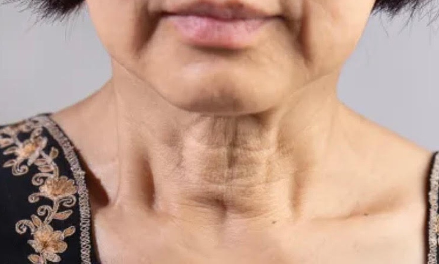 Image 1: Up to 50% Off on Radio Frequency Skin Tightening at Forever YOU Dermal Clinic