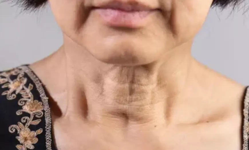 Image 1: Enhanced HIFU Skin Tightenings + Plasma Pen Treatment