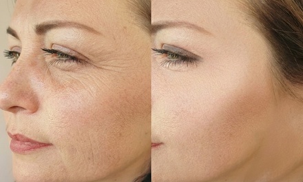 20 Units of Botox - Hush Aesthetics, LLC