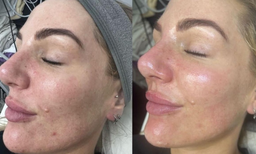 Image 2: Relax and Unwind with One, Two, or Three 45-Minute HydraFacials