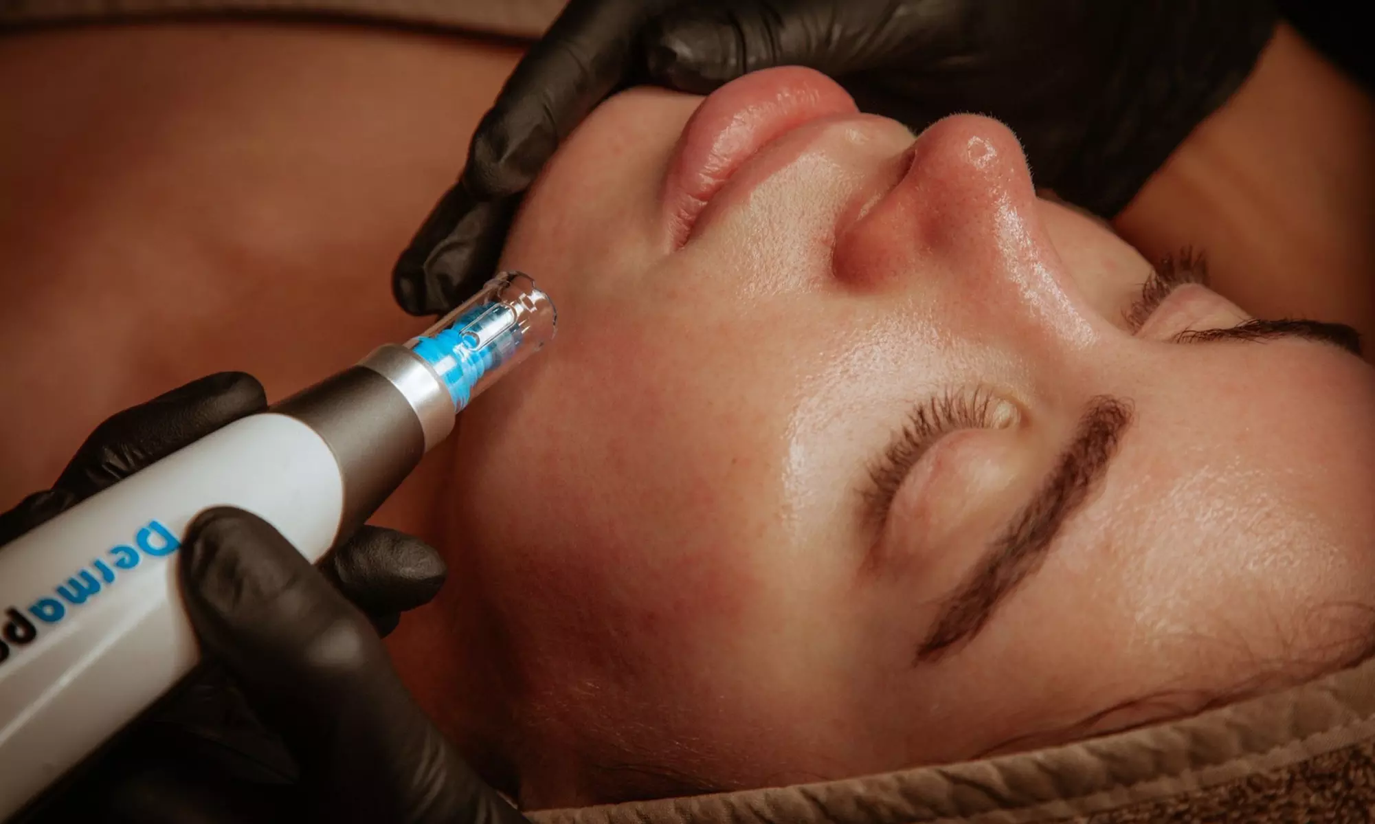 1 oder 2x 60 Min. kosmetisches Microneedling inkl. LED-Therapie