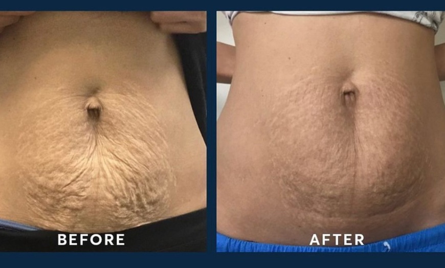 Image 3: One, Two, or Three Sessions RF Microneedling + InMode Morpheus8 