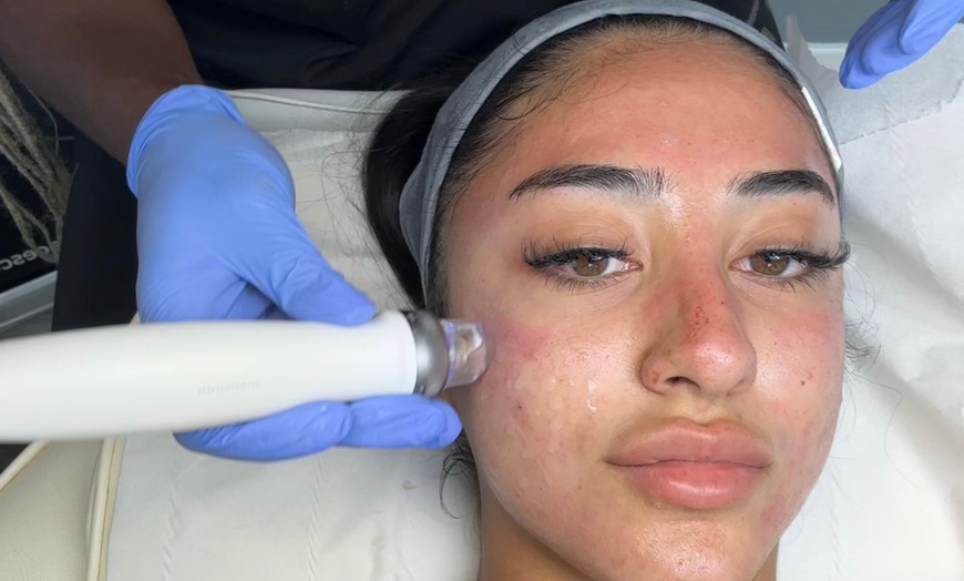 Image 2: Advanced Micro-needling w/ Luxury Hydrating Serums - Face and/or Neck