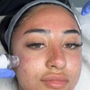 Image 2: Advanced Micro-needling w/ Luxury Hydrating Serums - Face and/or Neck