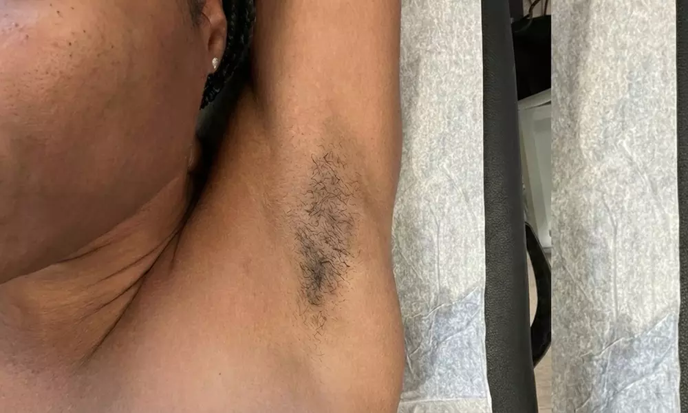 Get Silky Smooth Skin with One, Three, or Five Bikini Waxing Packages