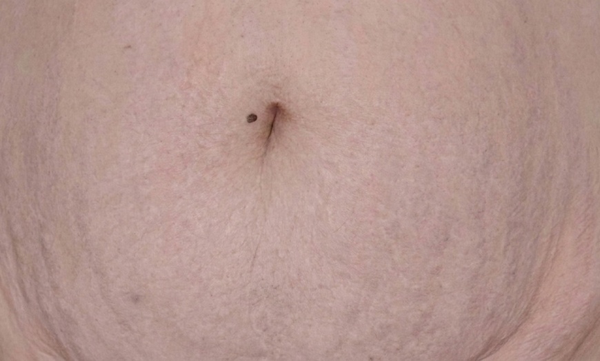 Image 4: Advanced PMU: Improve Scars & Stretch Marks for Smoother Skin