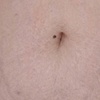 Image 4: Advanced PMU: Improve Scars & Stretch Marks for Smoother Skin