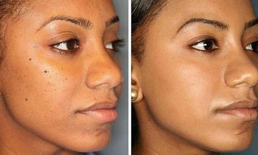 Image 2: Get Face, Neck, or Chest Lamprobe Treatment