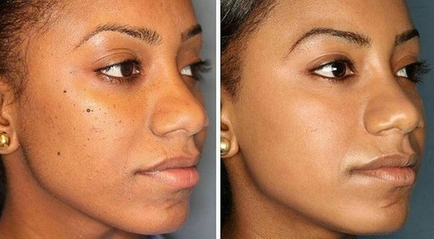 Get Face, Neck, or Chest Lamprobe Treatment