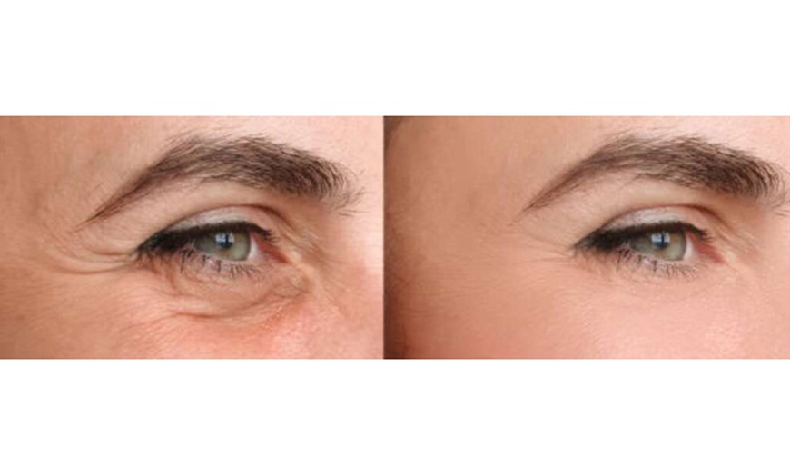 Image 2: Advanced Skin Regeneration with 1,2,or 3 Sessions of Polynucleotide 