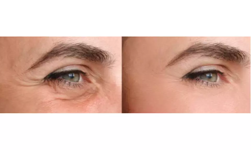 Advanced Skin Regeneration with 1,2,or 3 Sessions of Polynucleotide