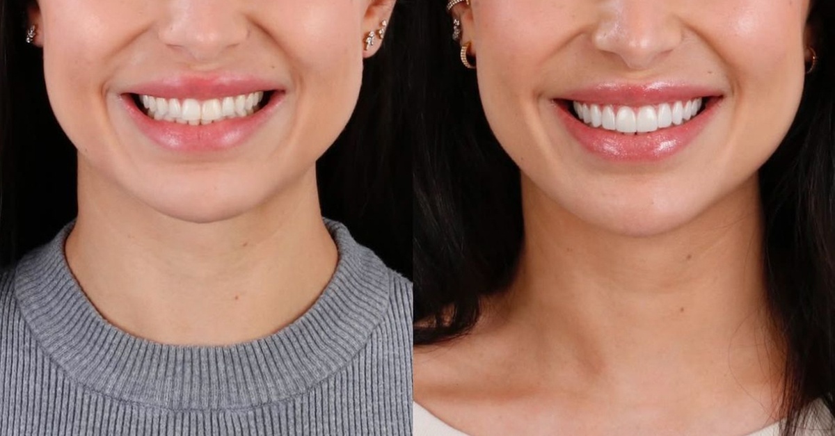 Colocación de carillas dentales de composite o cerámica en Barcelona