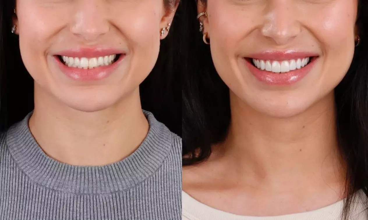 Colocación de hasta 4 carillas dentales de composite o cerámica