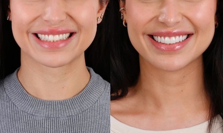 Colocación de carillas dentales: Composite / 2 carillas