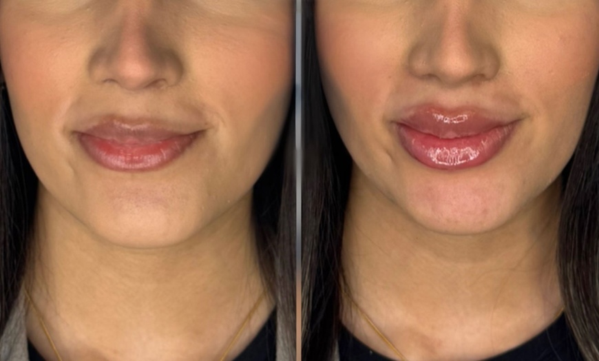 Image 4: Revitalize with 0.5 or 1 ml of Revolax Dermal Filler with Consultation