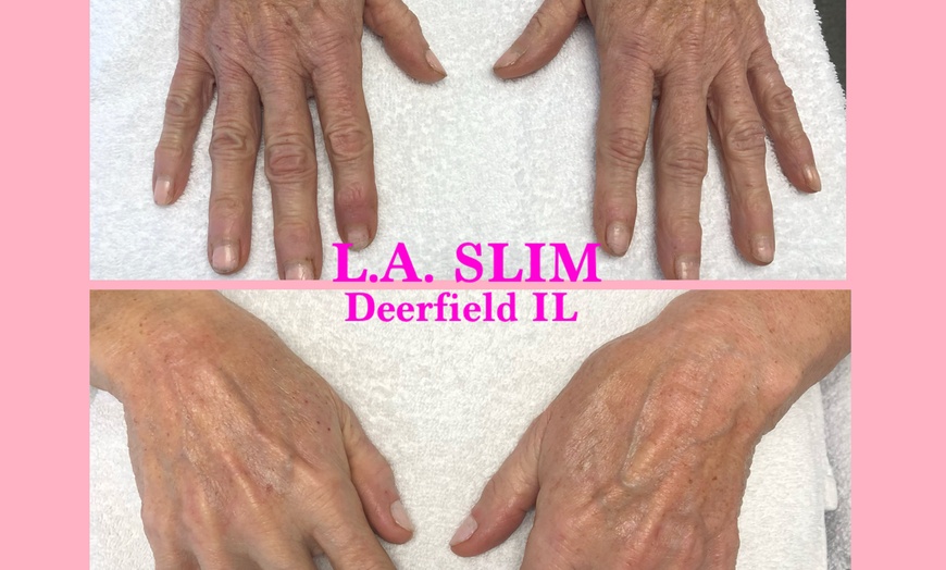 Image 2: Thermalift skin-tightening treatments for a contoured look
