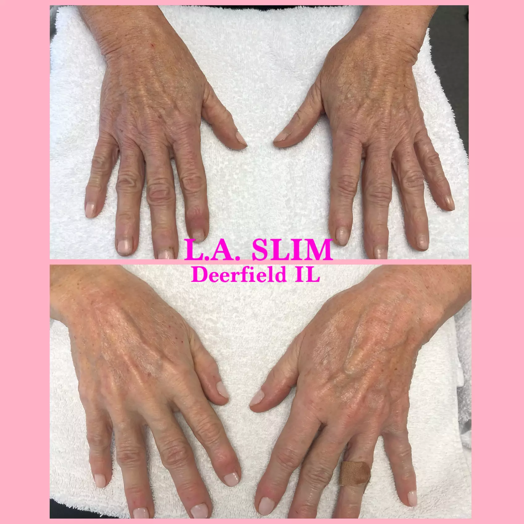 Thermalift skin-tightening treatments for a contoured look