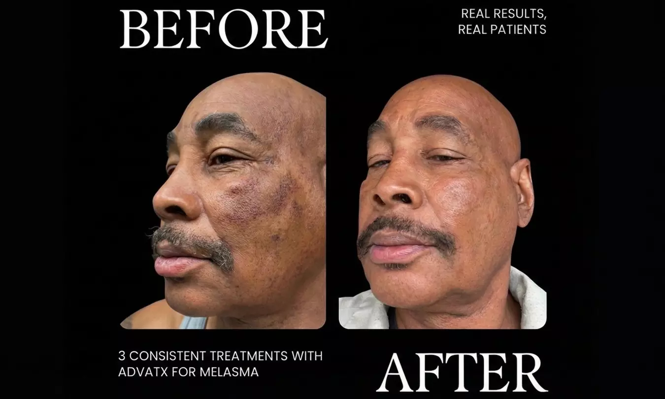 1, 2 or 3 45-Min AdvaTX Laser Skin Resurfacing & Rejuvenation Sessions