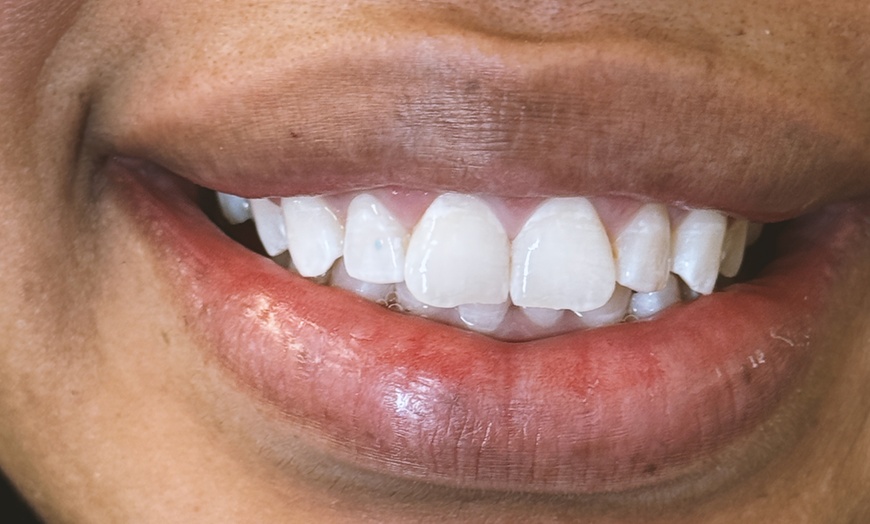 Image 2: Brighten Your Smile with 30 or 60 Minute Teeth Whitening Session 