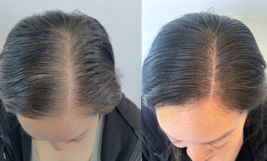 Image 3: Restore Hair Density With Partial Scalp Treatment