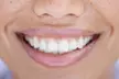 Achieve a Brighter Smile at The Laser Lab and Save Up to 79% Off - Second Medium
