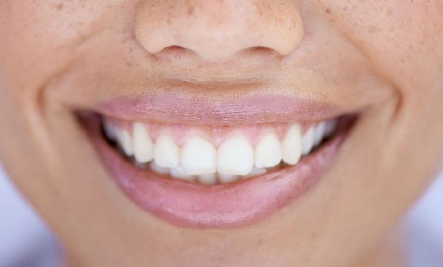 Image 3: Brighten Your Smile and Boost Your Confidence With Teeth Whitening