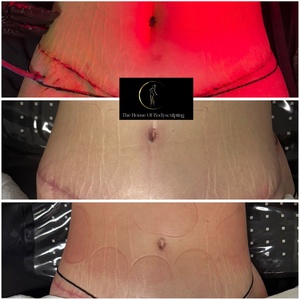 60-Min Targeted Lymphatic Massage with Radio Frequency for Detox & Toning + Free Belly Wrap - The House Of Body Sculpting
