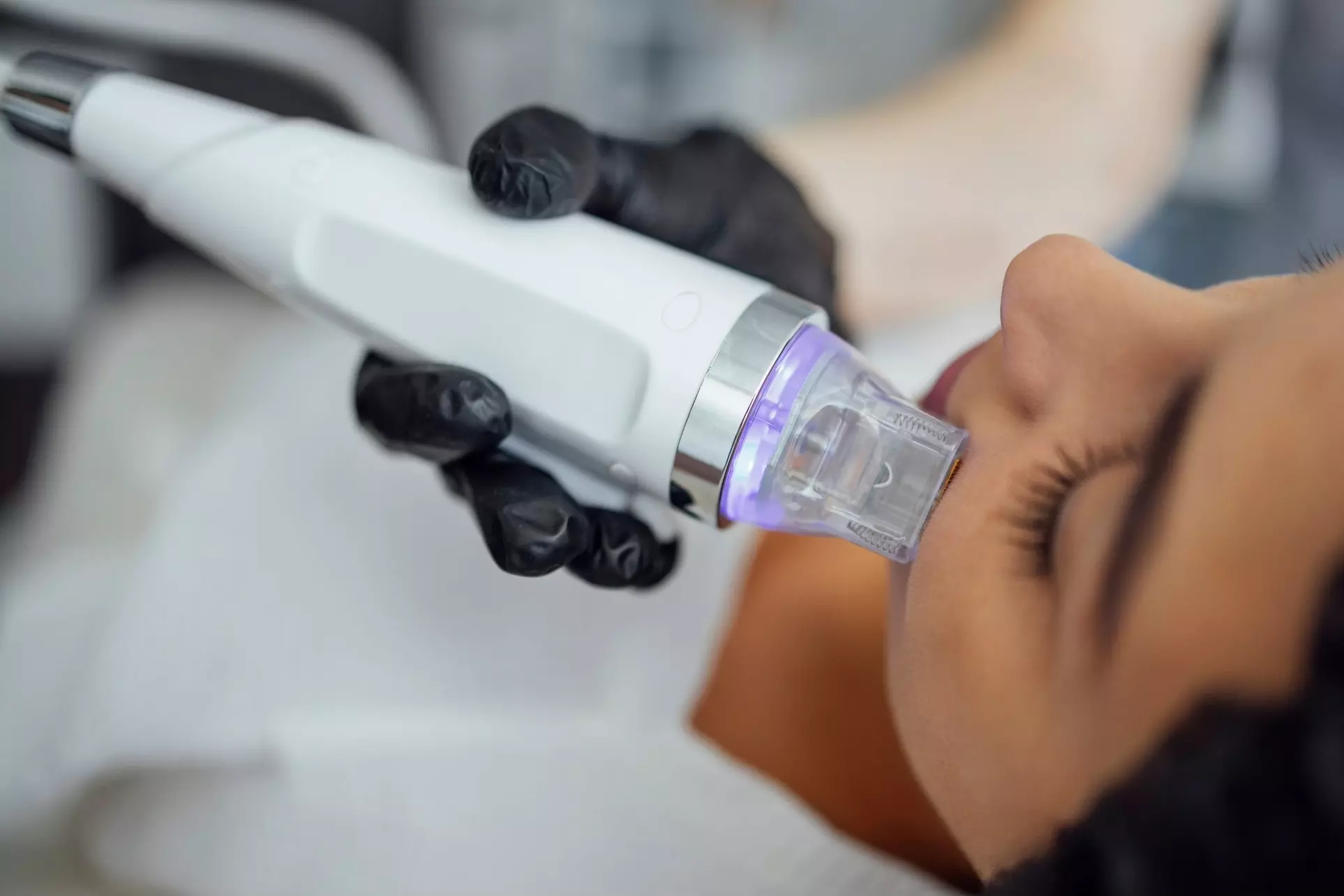 1, 2, or 3 Full Face & Neck Profound RF Microneedling + Rejuran Healer