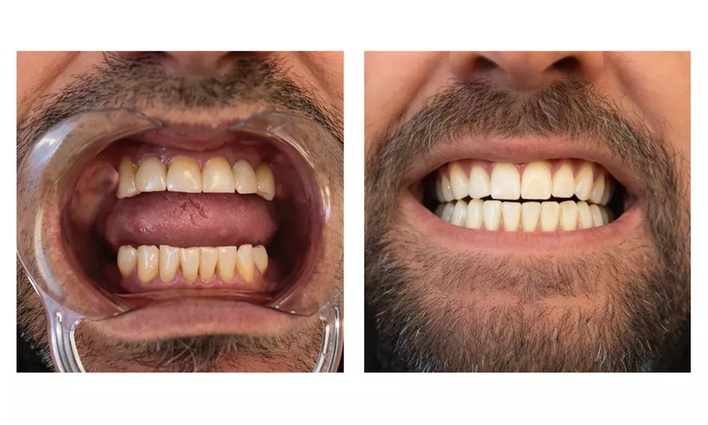 Teeth Whitening Treatment