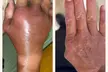 Up to 78% Off on Cryotherapy - Cryosurgery at Skin Memoirs by Arianna Nesbeth - Second Medium