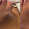 Image 1: Microneedling-Behandlung oder Enzym-Lifting-Paket für 1 Person