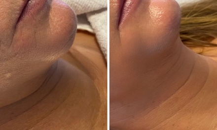 75 - 90 Min. Microneedling-Behandlung mit hochwertigen Cocktails–für ein gestärktes Hautbild  - Harzer DermaLaser | Dr.FAR LaserLounge