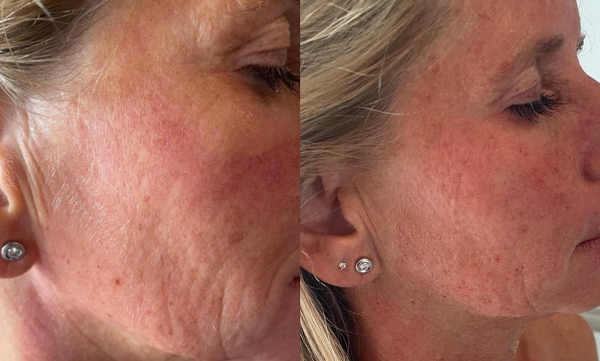 Image 2: Bis zu 70% Rabatt auf Micro-Needling bei Aestheticum skin