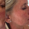 Image 2: Bis zu 70% Rabatt auf Micro-Needling bei Aestheticum skin