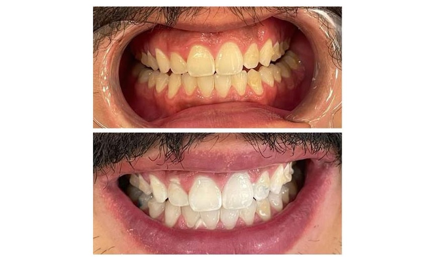 Image 3: Get Premium 60-Min Teeth Whitening For 1 or 2 People For Bright Smile 