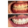 Image 3: Get Premium 60-Min Teeth Whitening For 1 or 2 People For Bright Smile 