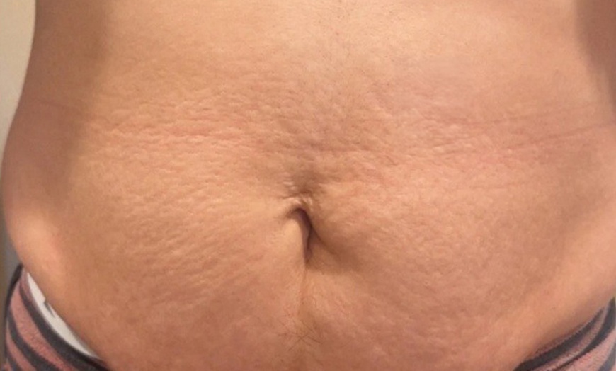 Image 3: Inkless Treatments for Stretch Marks & Scars on Various Body Areas