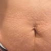 Image 3: Inkless Treatments for Stretch Marks & Scars on Various Body Areas