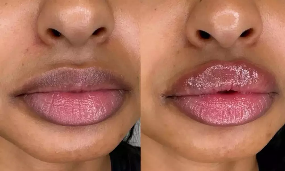 Rejuvenate with One Half or Full Syringe of Revanesse Versa