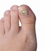Image 3: 4 Fungal Laser Treatment, 3 Ultrasound or PBM Laser or 1 PRF Treatment