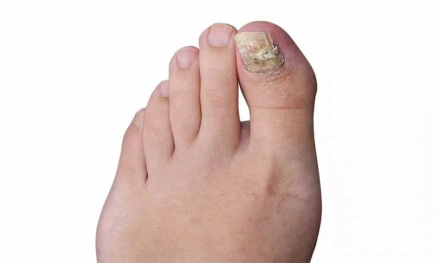 4 Fungal Laser Treatment for Both Big Toes, 3 Ultrasound or PBM Laser or 1 PRF Treatment (Up to 50% Off)