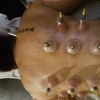 Image 2: Eastern Dry Cupping Therapy for Muscle Relief