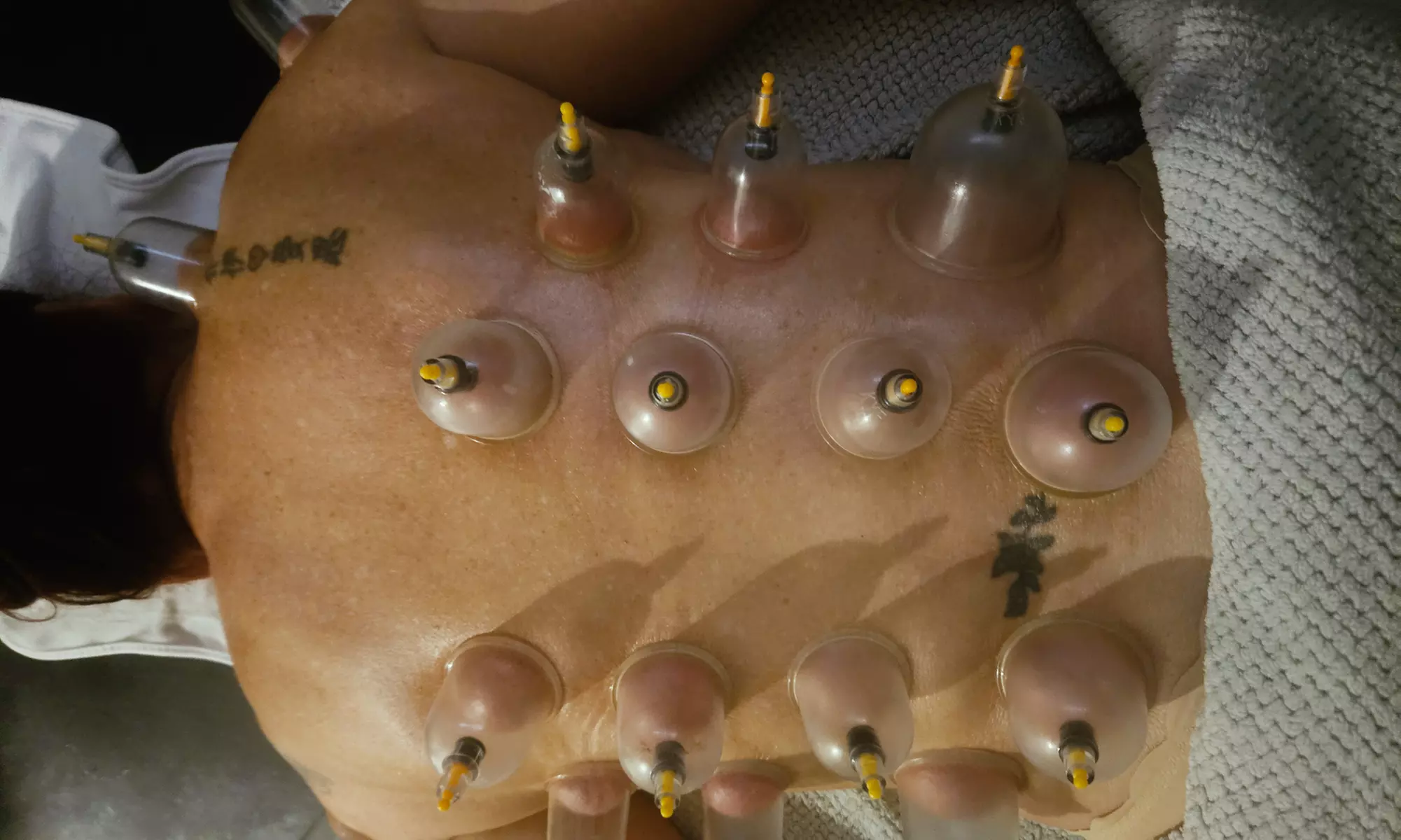 Eastern Dry Cupping Therapy for Muscle Relief