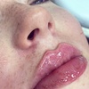 Image 1: 1ml Lips or 2ml choice of area of Premium Dermal Filler 