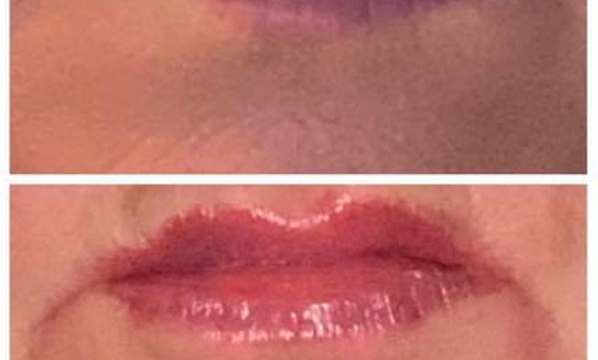 Image 4: Revanesse Versa Dermal Filler for Lips or Under Eyes