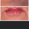 Image 4: Revanesse Versa Dermal Filler for Lips or Under Eyes